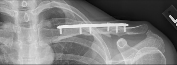 collarbone plate